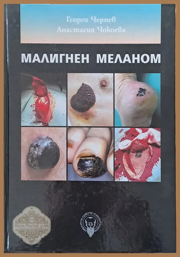 Малигнен меланом - Г. Чернев А. Чокоева - Книги