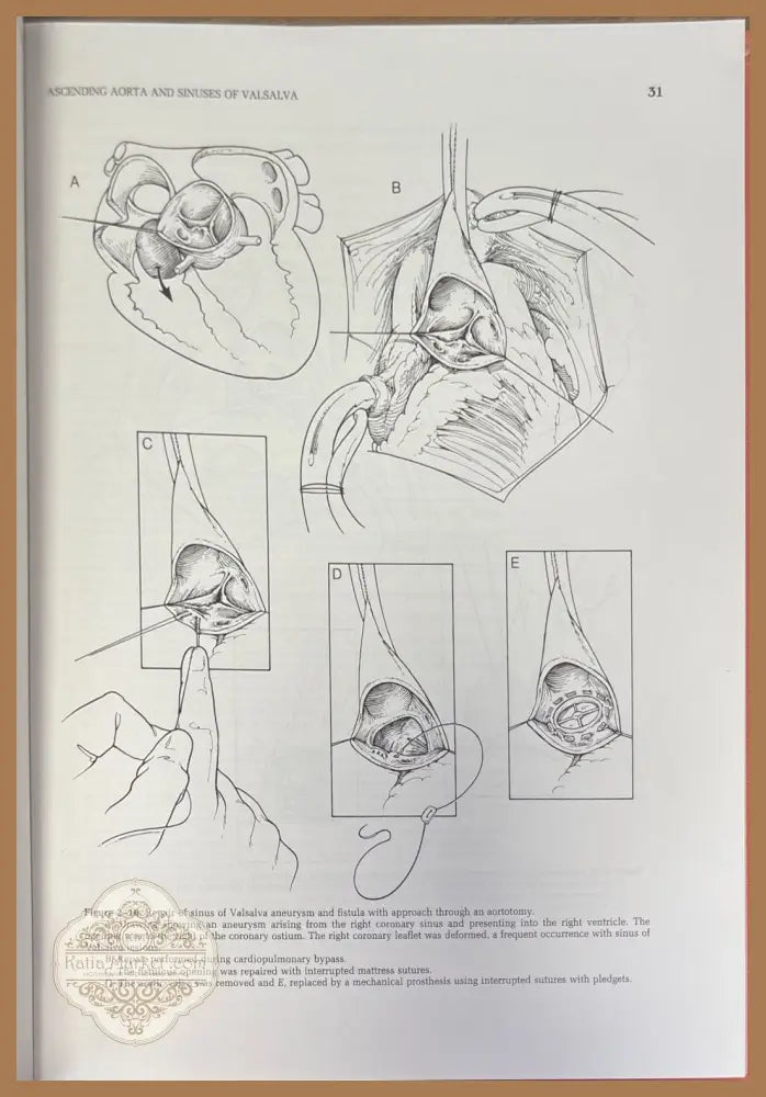Surgical treatment of aortic aneurysms - Denton A. Cooley - Книги