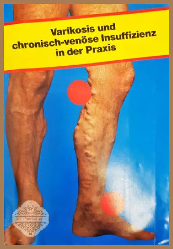 Varikosis und chronisch-venöse Insuffizienz in der Praxis - Hübner, Marshall